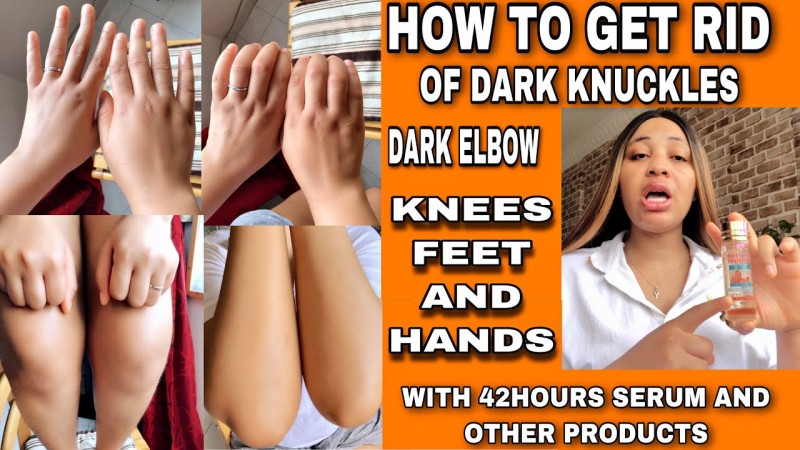 Dark Knuckle Whitening Serum Hand Elbow Knee Brightening Serum In Lisnaskea Town in Northern Ireland Call +2771 073 2372 Get Rid Of Scars And Stretch Marks In Johannesburg South Africa And Kilwa Masoko Town In Tanzania