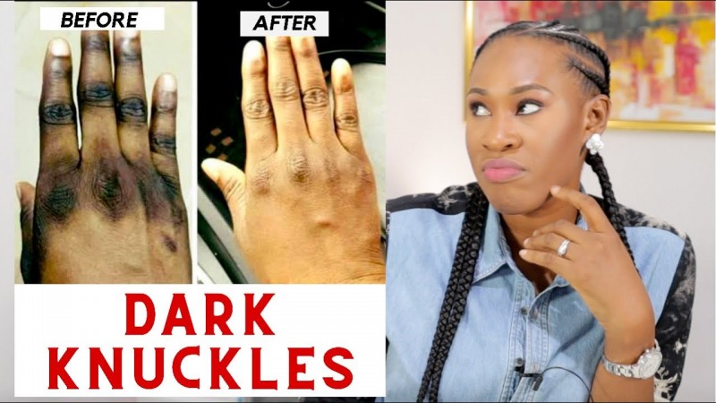 Dark Knuckle Whitening Serum Hand Elbow Knee Brightening Serum In Lisnaskea Town in Northern Ireland Call +2771 073 2372 Get Rid Of Scars And Stretch Marks In Johannesburg South Africa And Kilwa Masoko Town In Tanzania