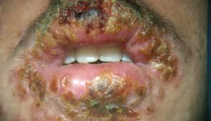 Herbal Products For The Treatment Of Herpes +27735222291- Amanzimtoti, Bluff, Glenmore, Glenwood, IsipingoBeach, Kingsborough, SouthBeach, Umkomaas, Drummond, Gillitts, Hillcrest, Kloof, NewGermany, Pinetown, Queensburgh, ReservoirHills, Waterfall, W