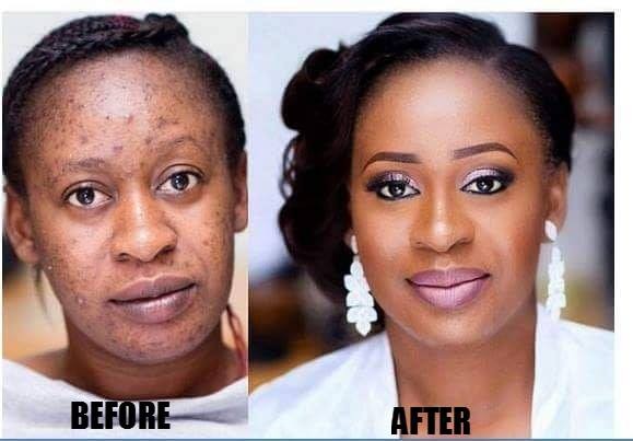 Permanent Skin Bleaching And Whitening Products In Ballycassidy Village In Northern Ireland Call ✆ +27710732372 Scars And Stretch Marks Removal Cream In Rustenburg, Louis Trichardt South Africa And Kasanga Town In Tanzania