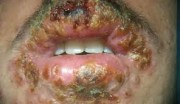 Herbal Products For The Treatment Of Herpes +27735222291- Amanzimtoti, Bluff, Glenmore, Glenwood, IsipingoBeach, Kingsborough, SouthBeach, Umkomaas, Drummond, Gillitts, Hillcrest, Kloof, NewGermany, Pinetown, Queensburgh, ReservoirHills, Waterfall, W